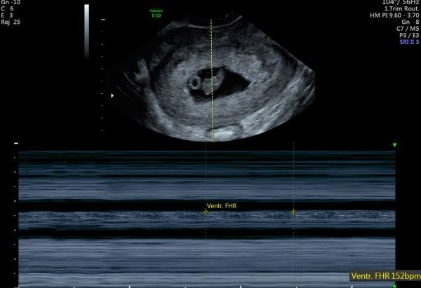 Fetal heart beat