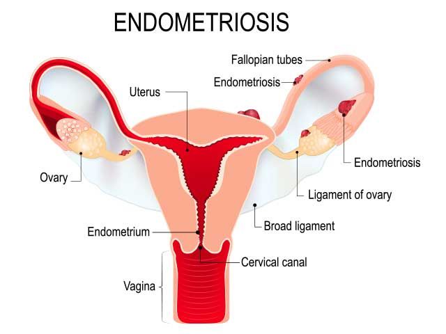 Endometriosis illustration