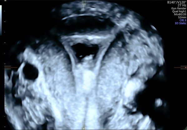 3D Sono uterus