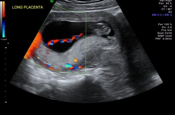 Placenta 12 cropped
