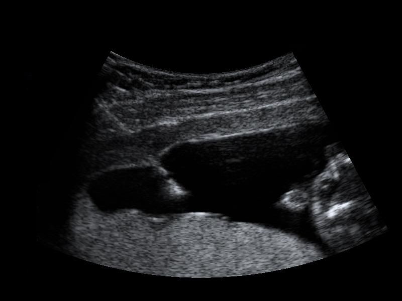 Amniocentesis ultrasound