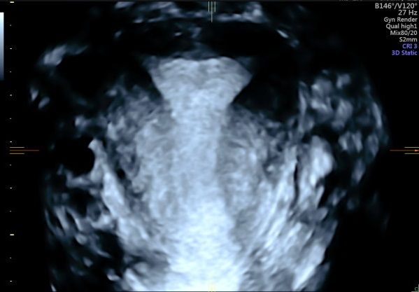 3D image of uterus and C-plane reconstruction