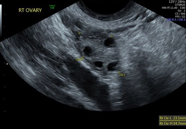 Right ovary displaying antral follicles